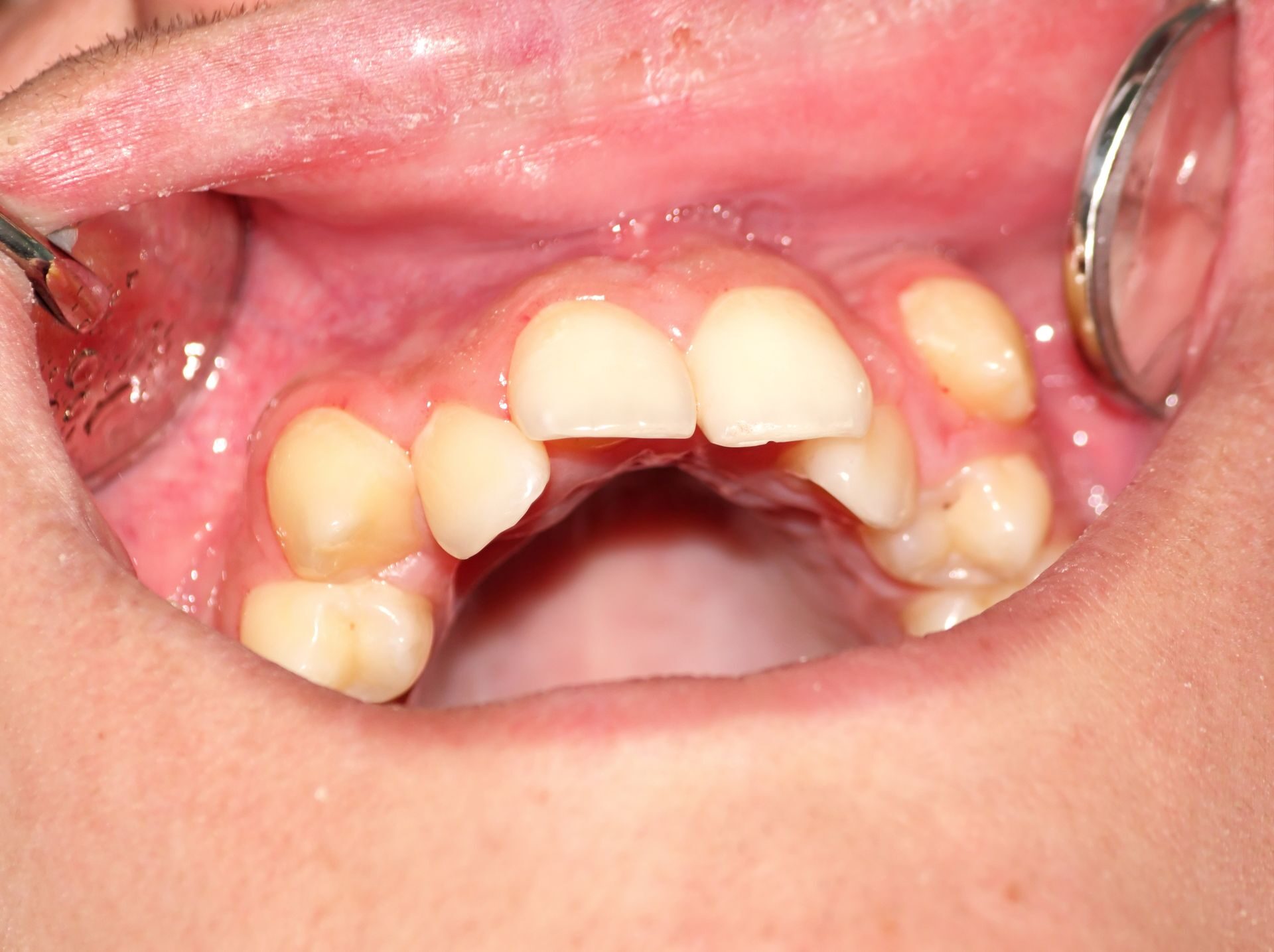 malocclusion_6